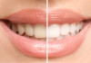 Clareamento Dental: 3 métodos que realmente funcionam!