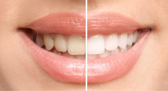 Clareamento Dental: 3 métodos que realmente funcionam!