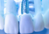 Implante dentário e seu avanço tecnológico