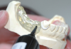 Prótese Dentária: Conheça a diferença entre a prótese total e o protocolo
