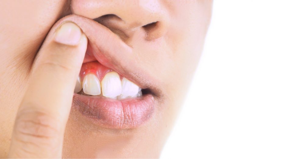 Pessoa com dedo na boca mostrando gengiva inflamada